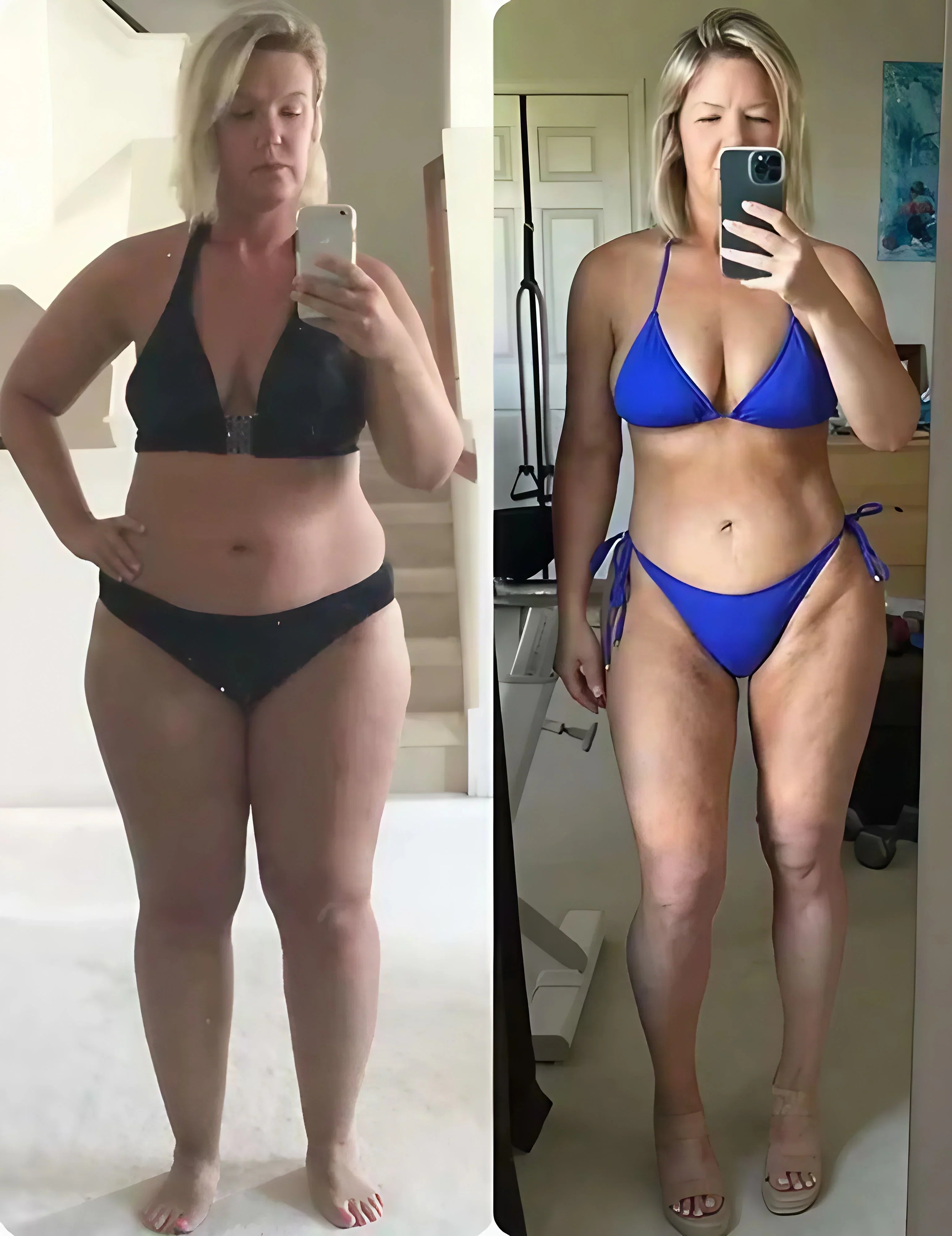 Natural repair of fat cells makes lipoedema disappear completely without surgery and ensures slim, pain-free legs